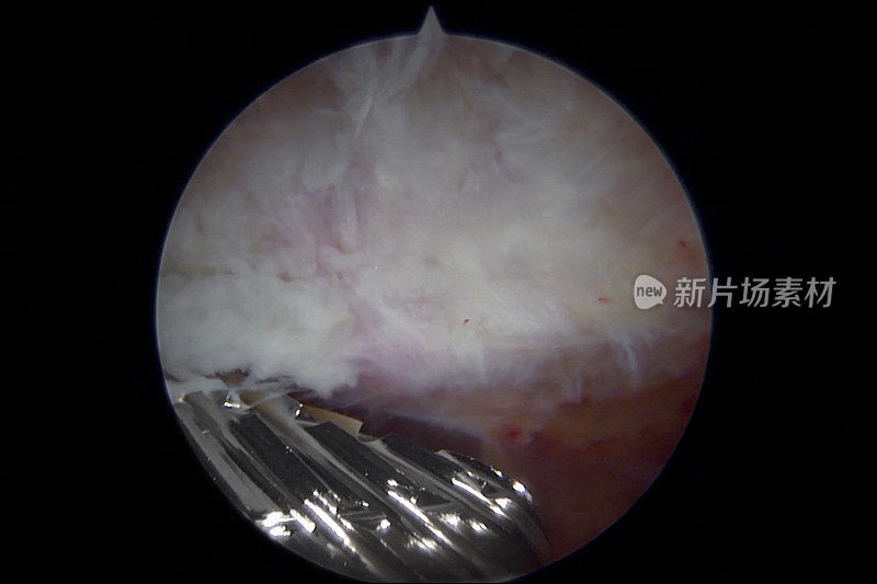 关节镜下左肩锁关节和骨切除/毛刺治疗AC骨关节炎